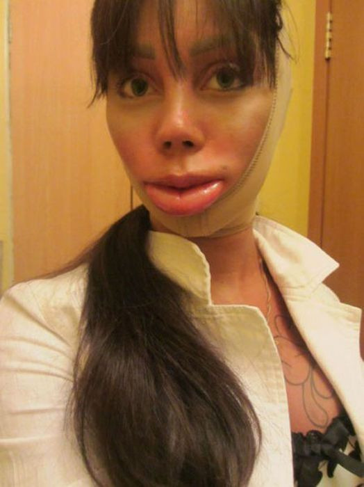 Alyona sau một ca phẫu thuật