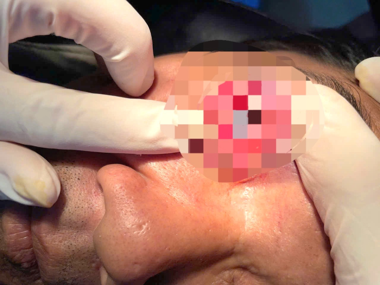 Thời điểm bệnh nhân Nguyễn Anh Sơn nhập viện được tiên lượng rất nặng