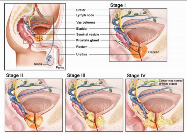 10 dấu hiệu cảnh báo ung thư sớm không thể làm ngơ ảnh 5