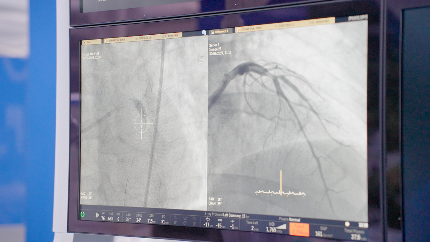 Bóng phủ thuốc là xu hướng điều trị tối ưu cho bệnh nhân nguy cơ chảy máu cao Bóng phủ thuốc là xu hướng điều trị tối ưu cho bệnh nhân nguy cơ chảy máu cao