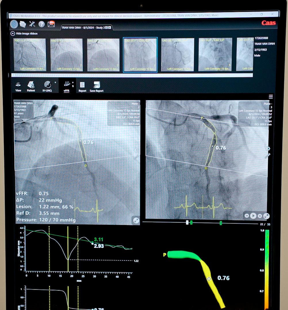 Tình trạng hẹp mạch vành của bệnh nhân được đo trên phần mềm vFFR Tình trạng hẹp mạch vành của bệnh nhân được đo trên phần mềm vFFR