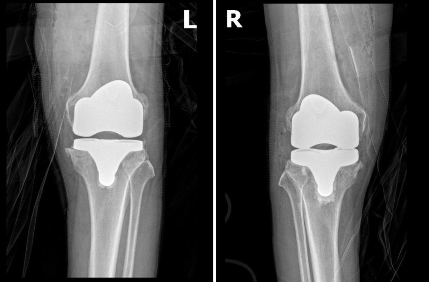 Phim chụp khớp gối bệnh nhân Thau sau phẫu thuật với khớp nhân tạo vừa vặn với trục chân, vận động trơn tru Phim chụp khớp gối bệnh nhân Thau sau phẫu thuật với khớp nhân tạo vừa vặn với trục chân, vận động trơn tru