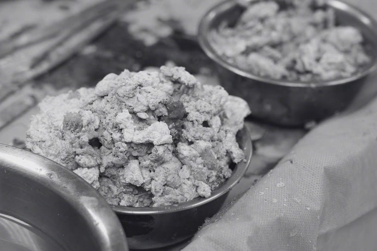 Lượng tinh thể urat được bóc tách ra từ 2 khớp gối của bệnh nhân Nam Lượng tinh thể urat được bóc tách ra từ 2 khớp gối của bệnh nhân Nam