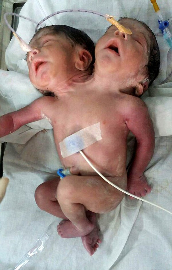 Bé trai hai đầu tử vong sau khi chào đời 32 giờ ảnh 1