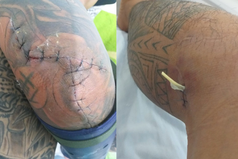 Vết thương trên người anh P. Vết thương trên người anh P.