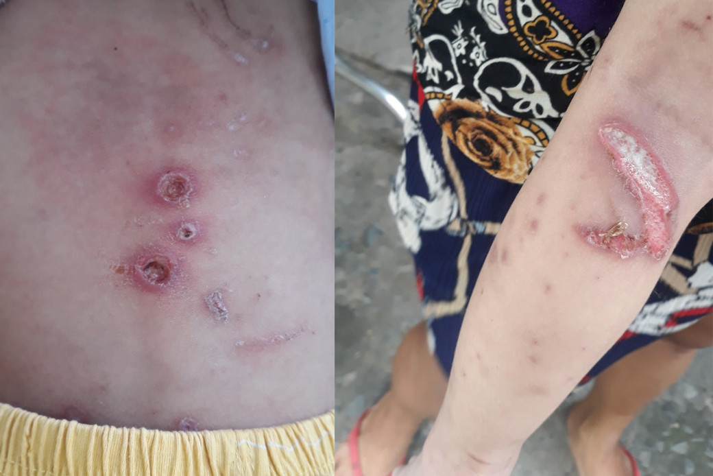 Vết thương trên người bé trai nghi do bị cha mẹ bạo hành. Ảnh người dân cung cấp.