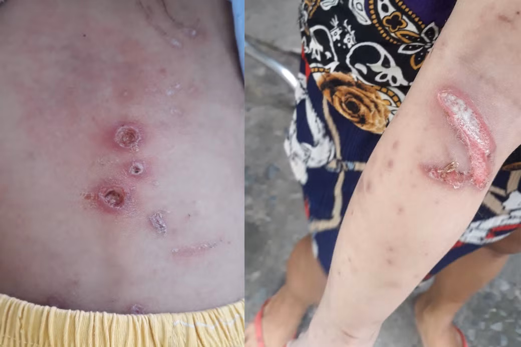 Vết thương trên người bé trai nghi do bị cha mẹ bạo hành. Ảnh người dân cung cấp. Vết thương trên người bé trai nghi do bị cha mẹ bạo hành. Ảnh người dân cung cấp.