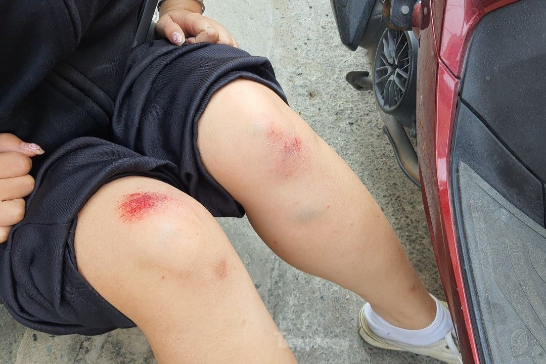 Vết thương trên chân chị T khi bị kéo ngã xuống đường. Ảnh: Hoàng Thuận. Vết thương trên chân chị T khi bị kéo ngã xuống đường. Ảnh: Hoàng Thuận.