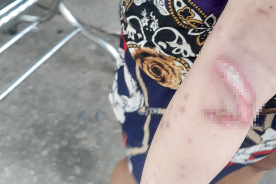 Vết thương trên chân của bé trai. Ảnh người dân cung cấp.