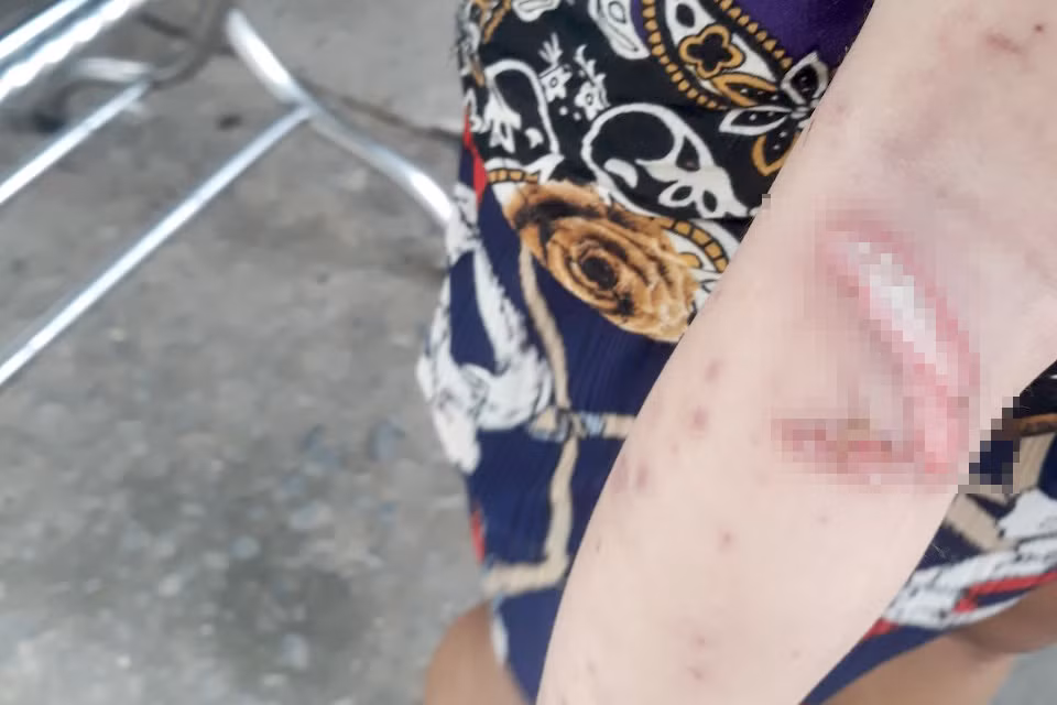 Vết thương trên chân của bé trai. Ảnh người dân cung cấp. Vết thương trên chân của bé trai. Ảnh người dân cung cấp.