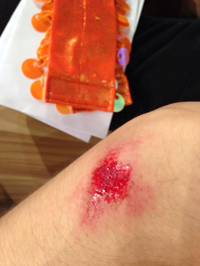 Thảo Trang chụp ảnh chân bị té bầm dập trong đêm thi