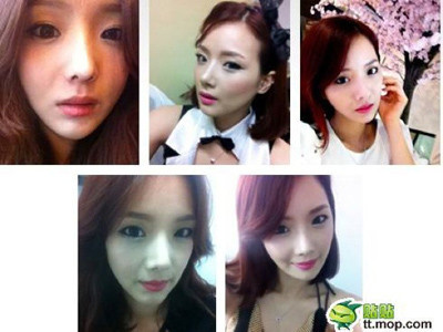 6 tháng sau khi phẫu thuật thẩm mỹ 