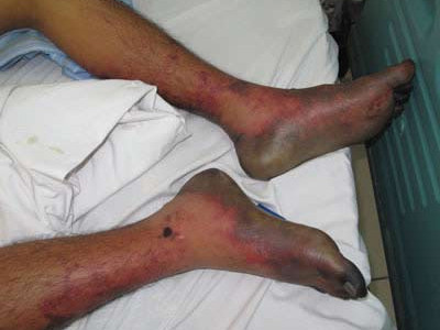 Một bệnh nhân bị nhiễm trùng huyết do liên cầu lợn, xuất hiện các ban hoại tử trên da và bị hoại tử cả bàn chân. Ảnh: H.Hải