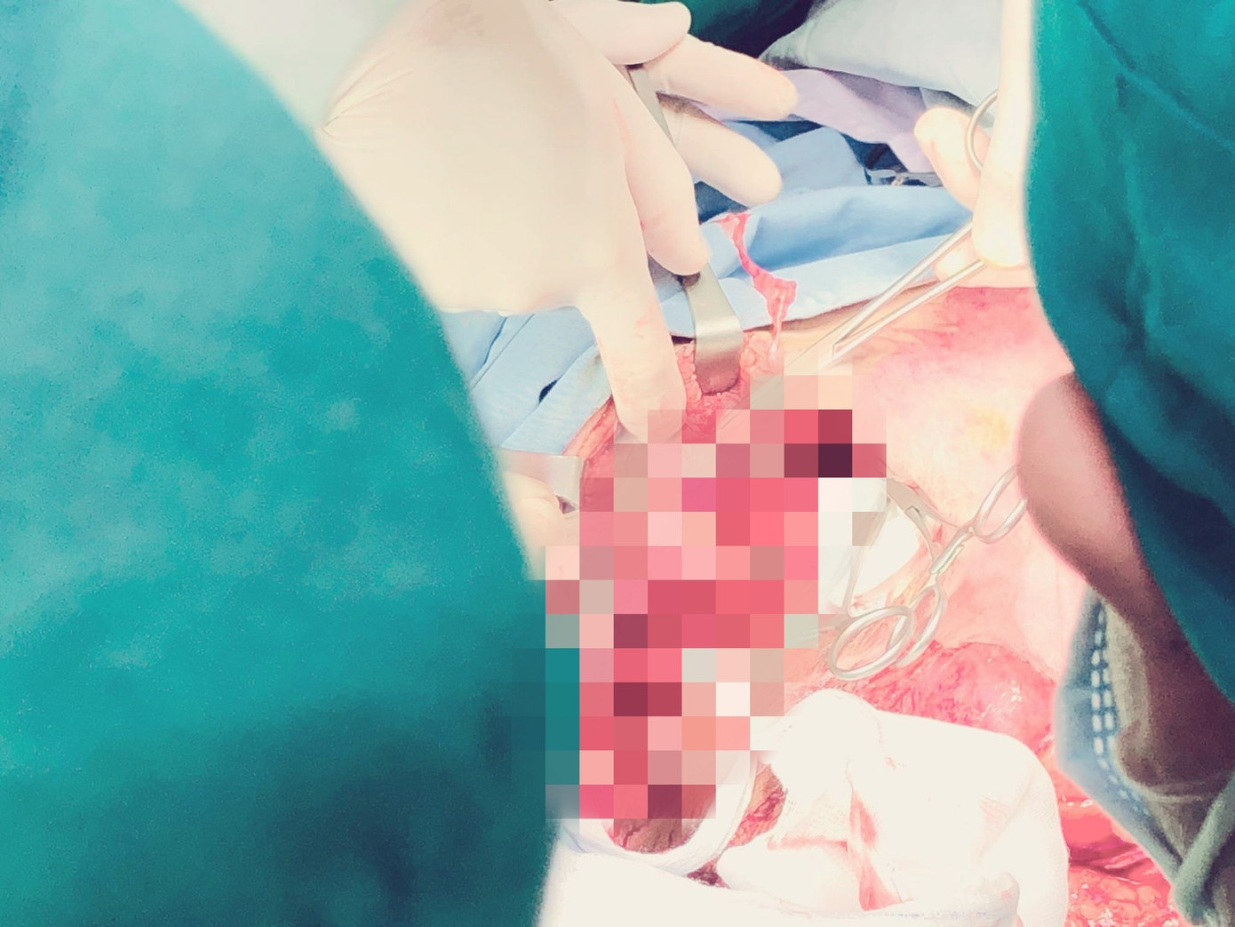 20 bác sĩ căng não trong 6 giờ cứu bé gái bị xe container tông nguy kịch ảnh 1