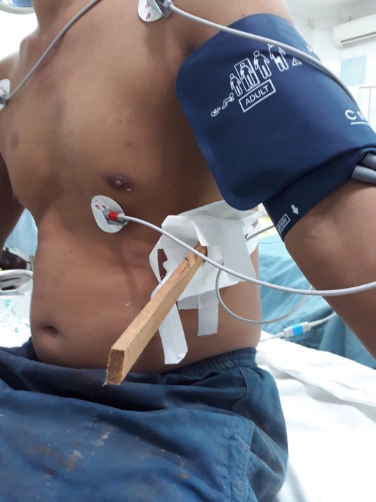 Lấy thành công mảnh gỗ nửa mét “đi lạc” vào ngực người thợ mộc ảnh 1