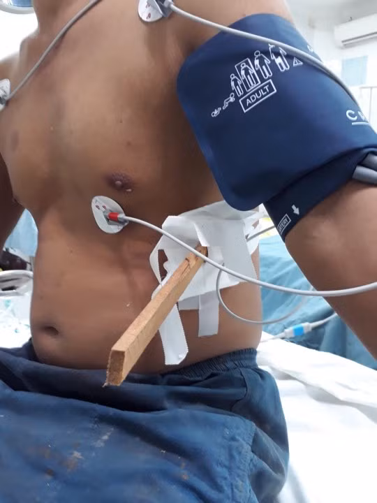 Lấy thành công mảnh gỗ nửa mét “đi lạc” vào ngực người thợ mộc ảnh 1
