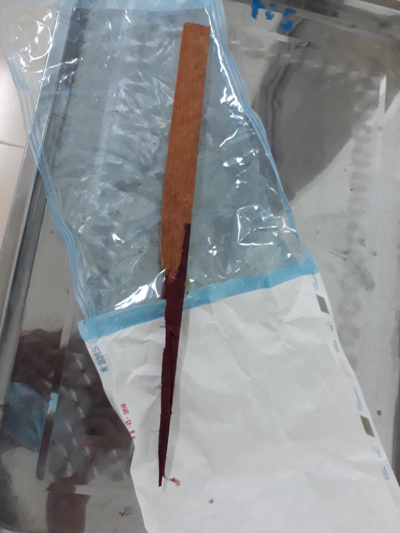 Lấy thành công mảnh gỗ nửa mét “đi lạc” vào ngực người thợ mộc ảnh 2