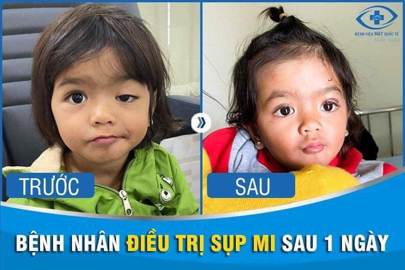 Bệnh nhân được điều trị sụp mi Bệnh nhân được điều trị sụp mi