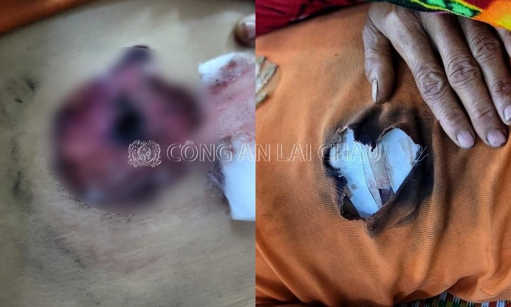 Chị M. bị chồng dùng bắn bị thương ở bụng. Chị M. bị chồng dùng bắn bị thương ở bụng.