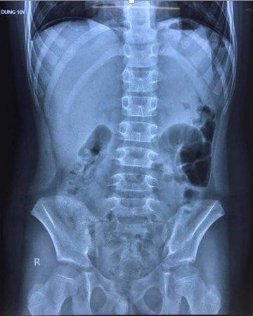 Hình ảnh chụp X-quang cho thấy bệnh nhi có liềm hơi dưới vòm hoành 2 bên, bác sĩ nghi thủng tạng rỗng. Ảnh: Bệnh viện Trẻ em Hải Phòng cung cấp.