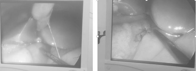 Lỗ thủng mặt trước môn vị được bác sĩ phát hiện khi mổ nội soi (ảnh trái) và tiến hành khâu lỗ thủng bằng phương pháp mổ nội soi (ảnh phải). Ảnh: Bệnh viện Trẻ em Hải Phòng cung cấp.