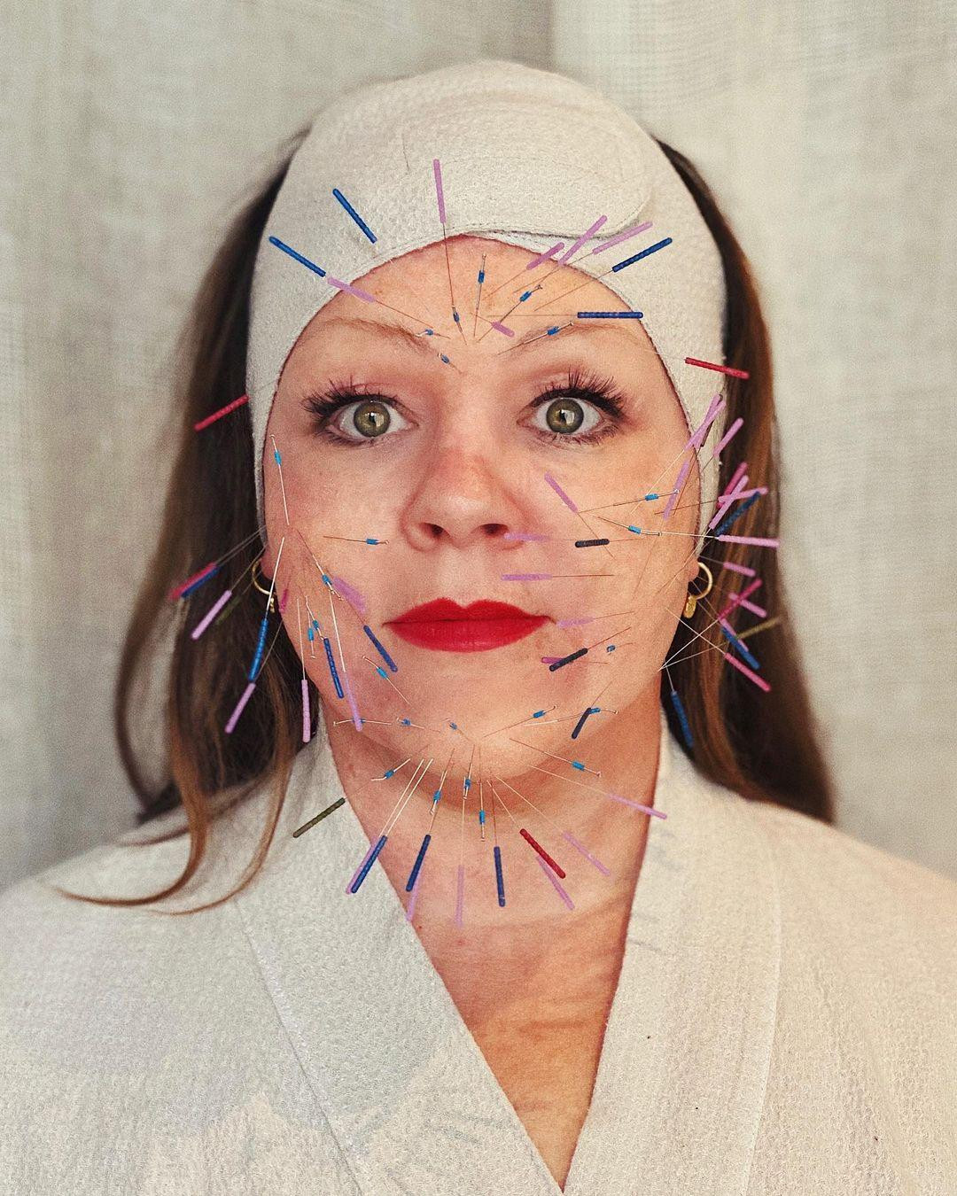 Khuôn mặt của nữ diễn viên Melissa McCarthy phủ kín kim châm trên phim trường "Nine Perfect Strangers". Ảnh: Instagram