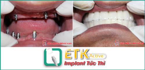 Ưu điểm của việc cấy ghép răng Implant ETK Active ảnh 5