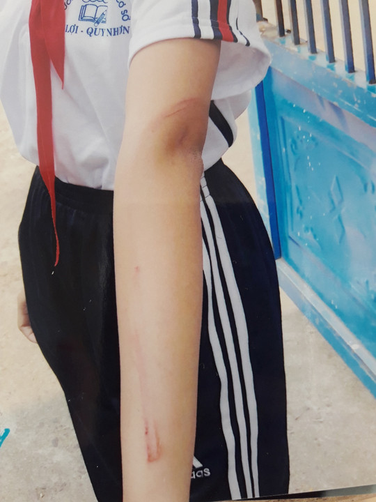 Cô bé 12 tuổi bị cha đánh phải nhập viện vì... 'ham chơi' ảnh 2