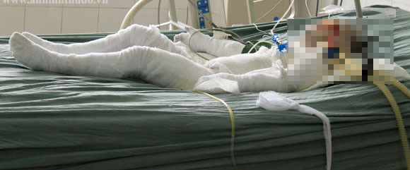 Cháu Ngọc đã tử vong sau 4 ngày điều trị tích cực tại Viện bỏng quốc gia. Cháu Ngọc đã tử vong sau 4 ngày điều trị tích cực tại Viện bỏng quốc gia