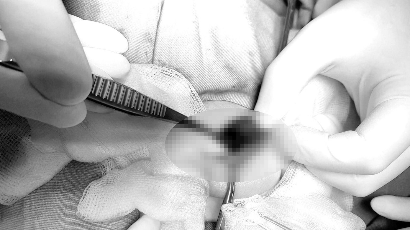 Tinh hoàn của bệnh nhi đã hoại tử, tím đen Tinh hoàn của bệnh nhi đã hoại tử, tím đen