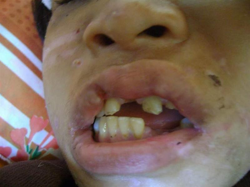 Hào Anh bị vợ chồng chủ trại tôm dùng kìm vặt gẫy 5 chiếc răng, mồm miệng biến dạng không thể ngậm vào được. Ảnh : T.H Hào Anh bị vợ chồng chủ trại tôm dùng kìm vặt gẫy 5 chiếc răng, mồm miệng biến dạng không thể ngậm vào được. Ảnh : T.H