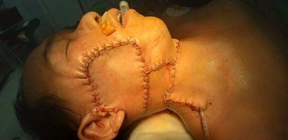 Bệnh nhân sau khi được bóc tách u và tạo hình lại má phải. Ảnh: BS cung cấp