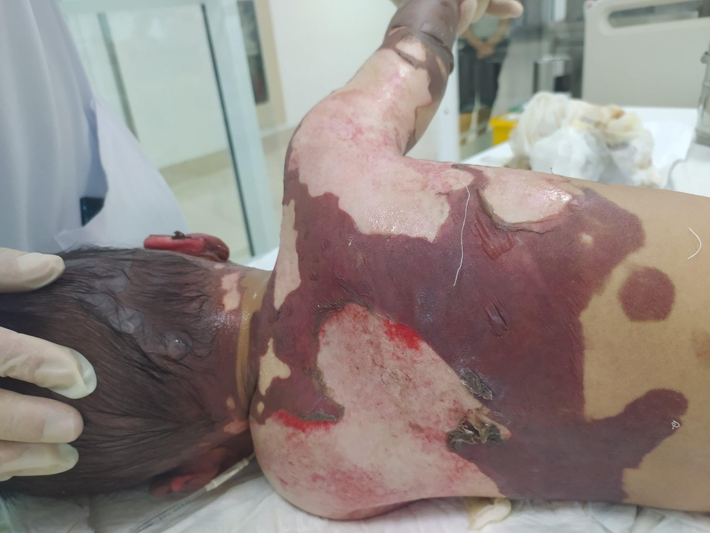 Hiện các vết bỏng ở trẻ đã lên da non, sức khỏe bệnh nhi đã tiến triển rất nhiều. Ảnh: BS cung cấp