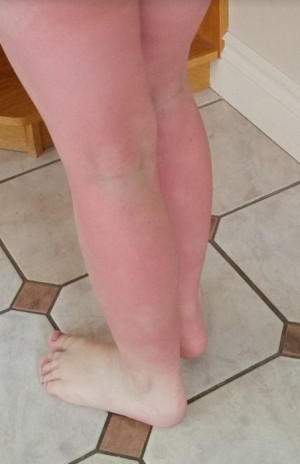 Lạ lùng cậu bé khắp người nổi ngứa vì dị ứng nước mắt ảnh 2