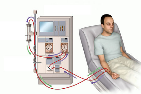 Những biến chứng thường gặp khi chạy thận nhân tạo ảnh 1