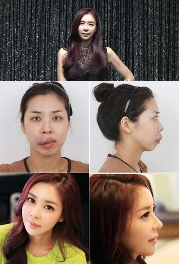 Trường hợp &quot;lột xác&quot; sau phẫu thuật thẩm mỹ trong Let Me In.