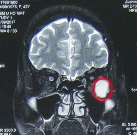 Phẫu thuật nội soi lấy khối u hốc mắt qua đường mũi ảnh 1