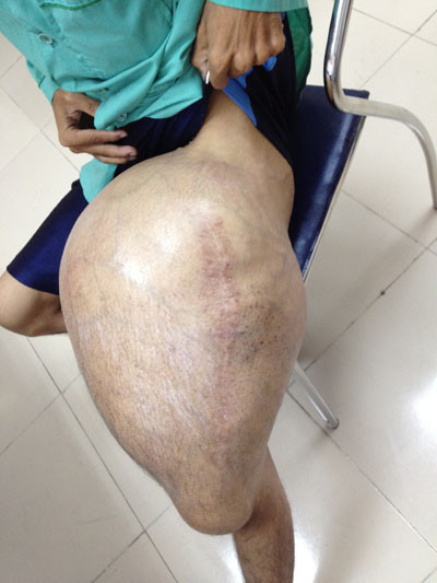 Bệnh nhân mang khối u trước khi lên bàn mổ