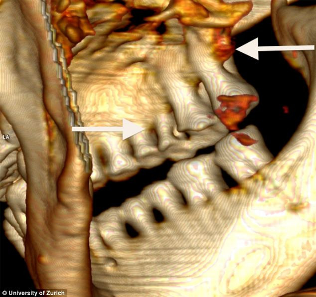 Người băng Otzi bị hôi miệng và sâu răng