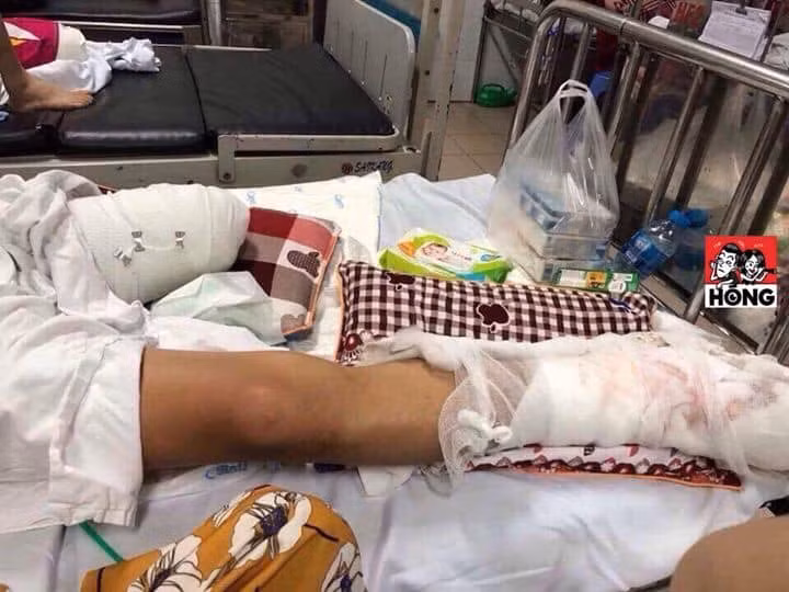Nhóm côn đồ bịt mặt đi ô tô chém nát chân 9X ảnh 1