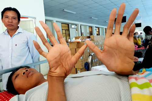 16 năm tăng chiều cao bất thường của bệnh nhân 2,5 m ảnh 2