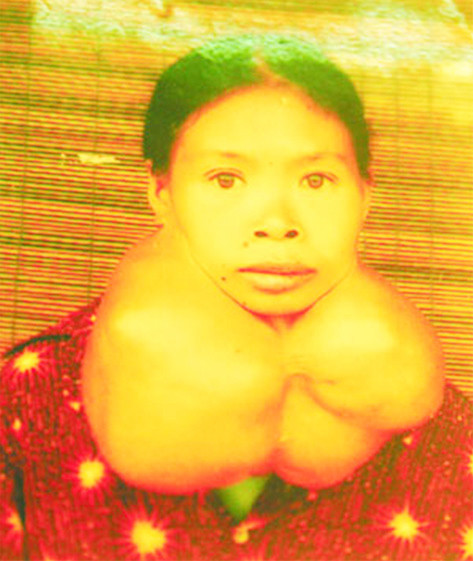 Chị Nguyễn Thị Xuân (33 tuổi, xã Hồng Minh, huyện Hưng Hà), con gái bà Bùi Thị Kim, cựu TNXP đại đội 895, bị di chứng nhiễm độc. Ảnh: Trần Hoàng