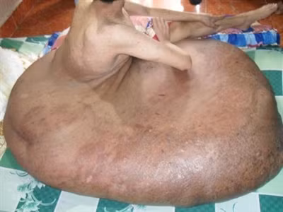 "Chân voi" khổng lồ khiến cuộc sống anh Hải khổ sở trong thời gian dài.