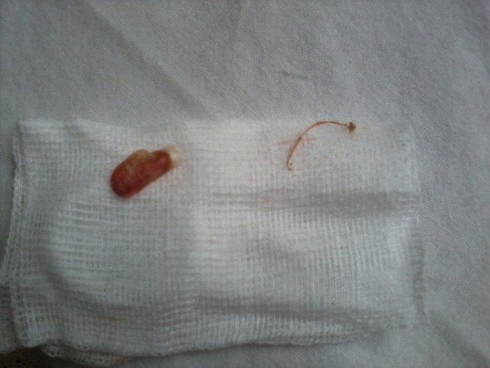  Ngón tay hoại tử của bé Y. khi chưa cắt cọng chỉ ra 