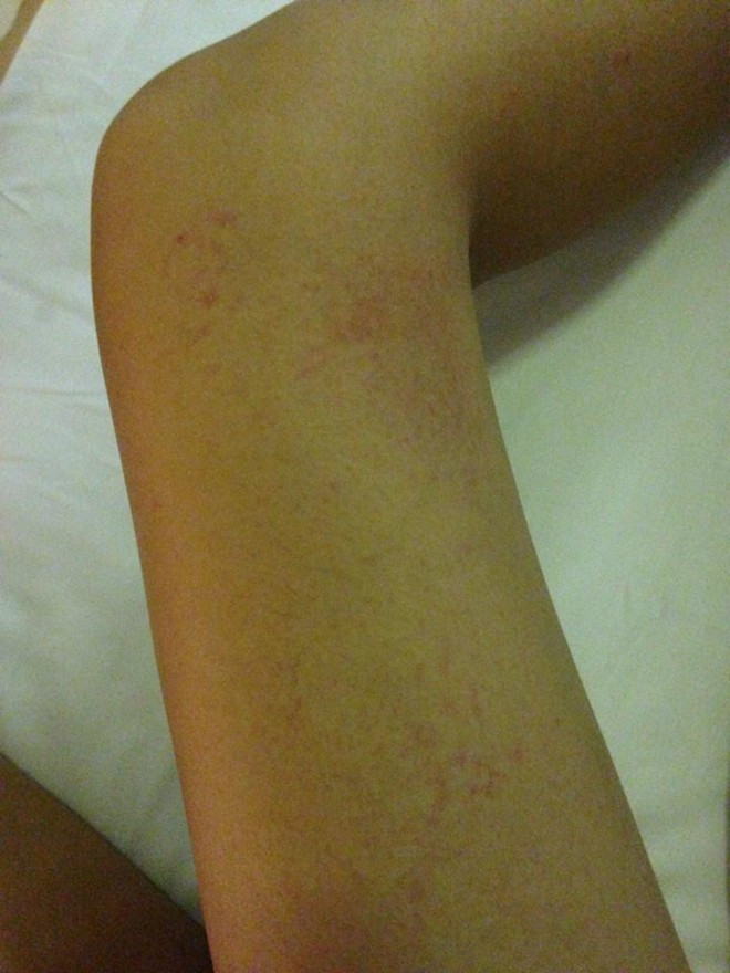 Chân tay bị thương