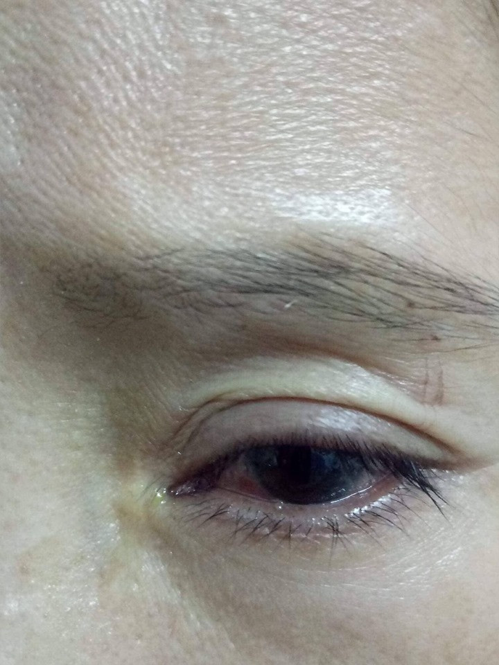 Nhập viện vì chim mổ vào mắt ảnh 2