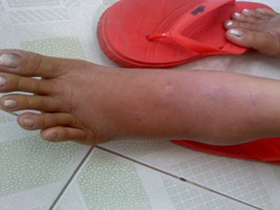 Chân bệnh nhân bị sưng to do có khối giun gây áp xe di chuyển