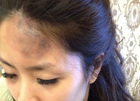 Nguyên đơn Tạ Hoàng Tâm và vết thương bị đánh 