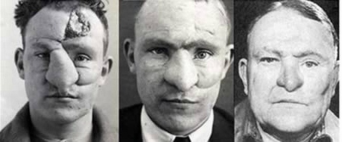 Phẫu thuật mũi: Ca phẫu thuật mũi đầu tiên cũng do bác sĩ Harold Gillies thực hiện. Tháng 1/1917, Trung úy William M. Spreckley trong tình trạng bị thương nặng ở mũi. Anh đã được bác sĩ Gillies phẫu thuật ghép lại mũi. Phải hơn 3,5 năm sau, Spreckley mới hồi phục hoàn toàn