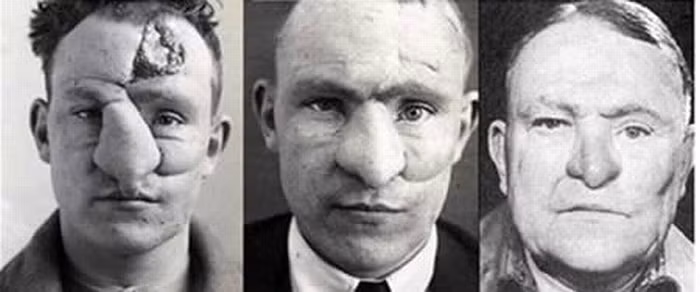 Phẫu thuật mũi: Ca phẫu thuật mũi đầu tiên cũng do bác sĩ Harold Gillies thực hiện. Tháng 1/1917, Trung úy William M. Spreckley trong tình trạng bị thương nặng ở mũi. Anh đã được bác sĩ Gillies phẫu thuật ghép lại mũi. Phải hơn 3,5 năm sau, Spreckley mới hồi phục hoàn toàn